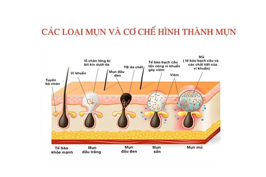 phan-biet-cac-loai-mun-va-co-che-hinh-thanh-mun